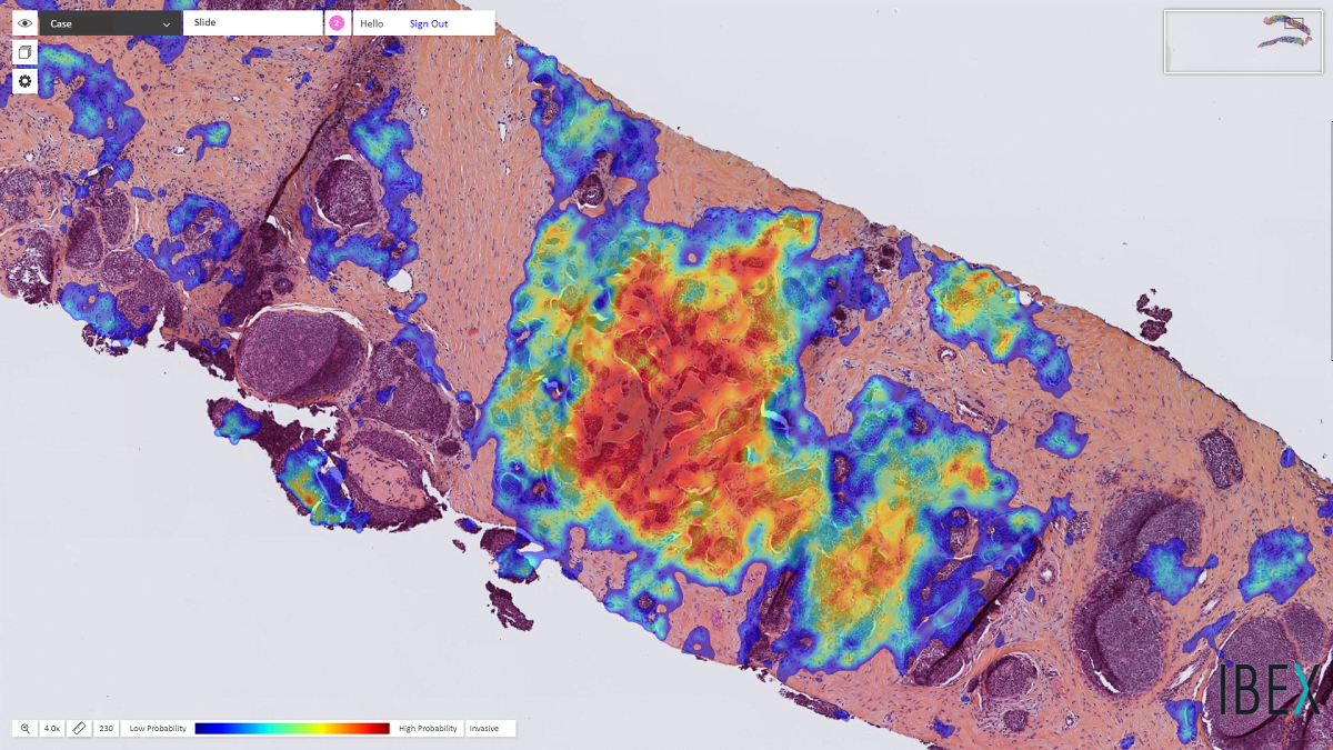 La piattaforma per la diagnosi del cancro al seno vince l’Edison Innovation Award 
